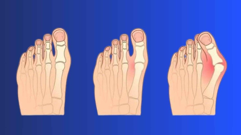 Halluks Valgus (Ayak Başparmak) Tedavisi ve Ameliyatı: A'dan Z'ye Rehber