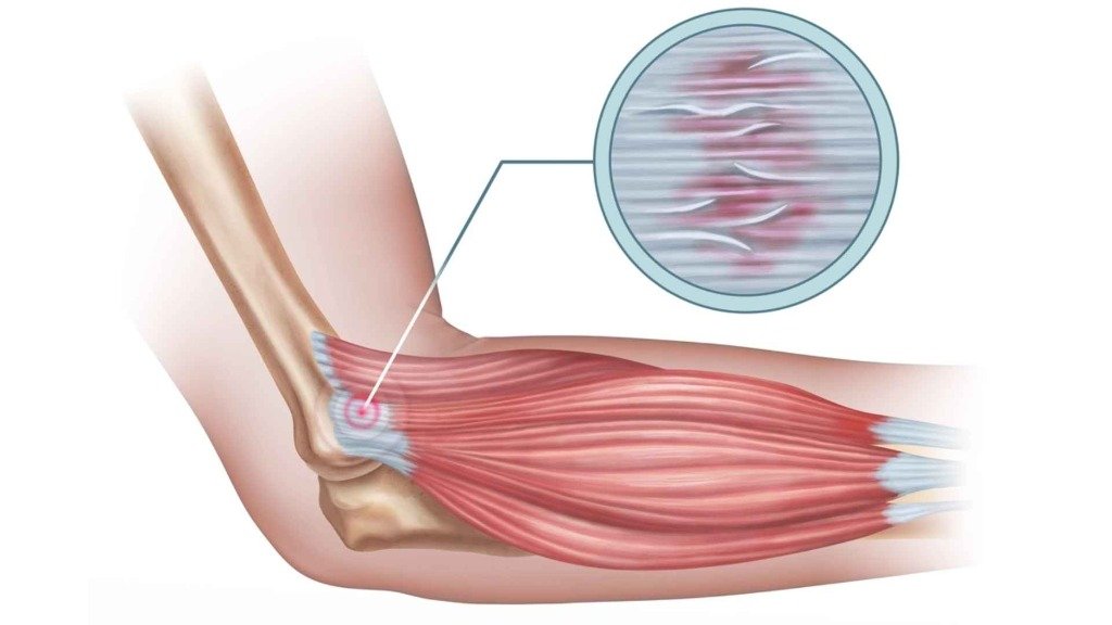 Tenisçi Dirseği (Lateral Epikondilit) Tedavisi ve Ameliyatı: A'dan Z'ye Rehber